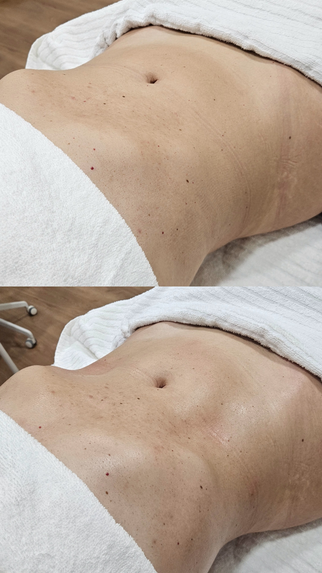 Antes e depois da drenagem linfática, resultado 4